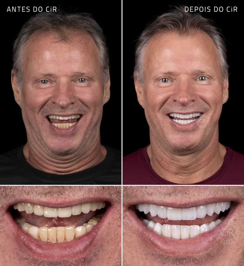 antes e depois da reabilitação oral com as as lentes de contato dental do paciente de 59 anos no cir atendimento premium lago sul lago norte park way noroeste sudoeste