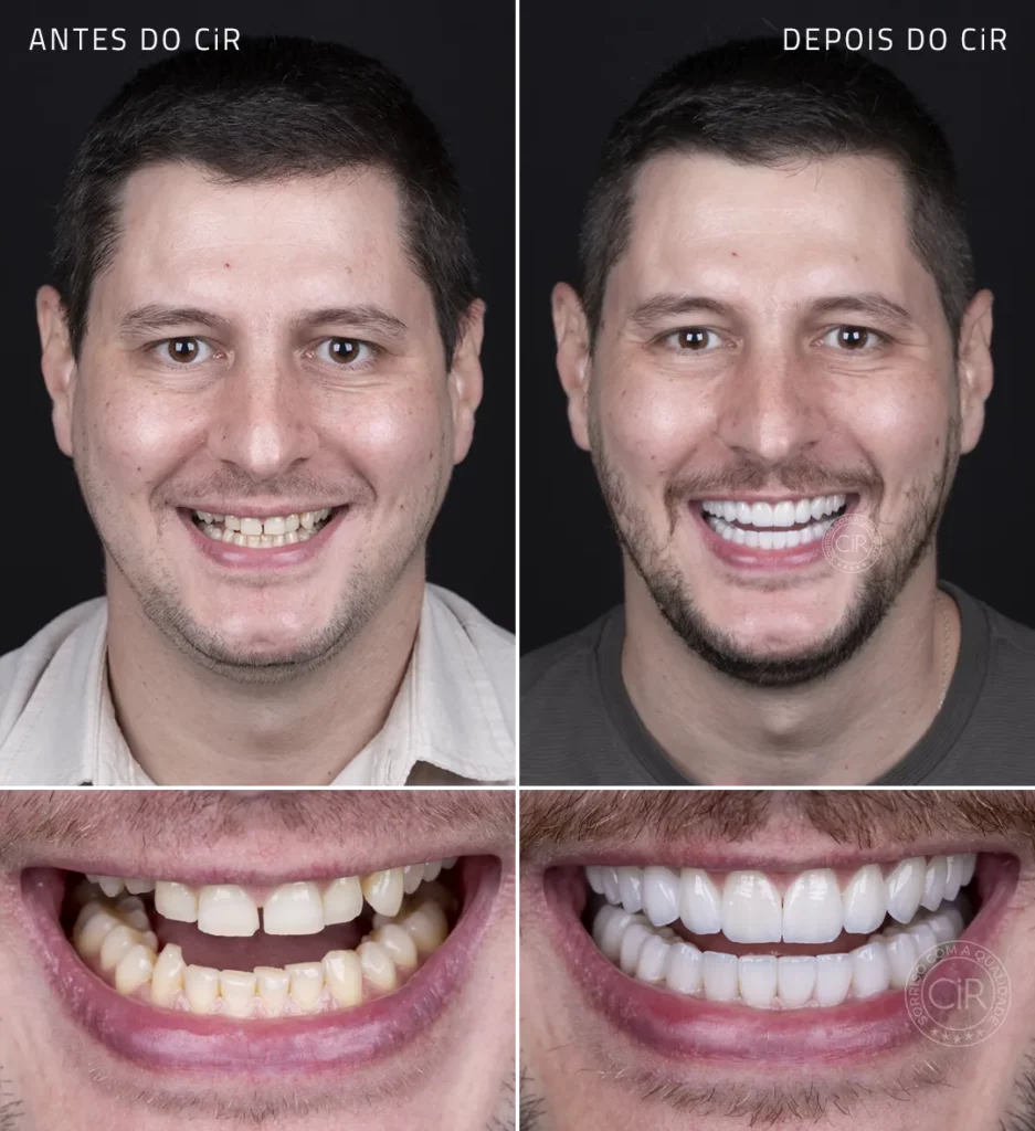 antes e depois da reabilitação oral com as as lentes de contato dental do paciente de 37 anos no cir atendimento premium lago sul lago norte park way noroeste sudoeste