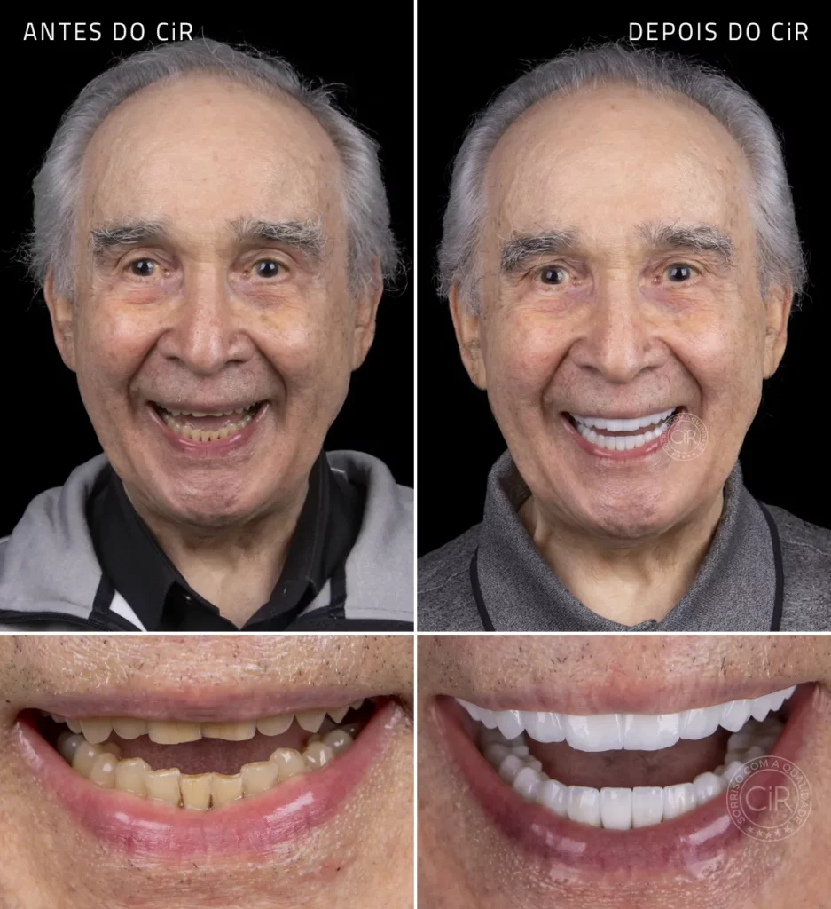 antes e depois da reabilitação oral com as as lentes de contato dental do paciente de 89 anos no cir atendimento premium lago sul lago norte park way noroeste sudoeste