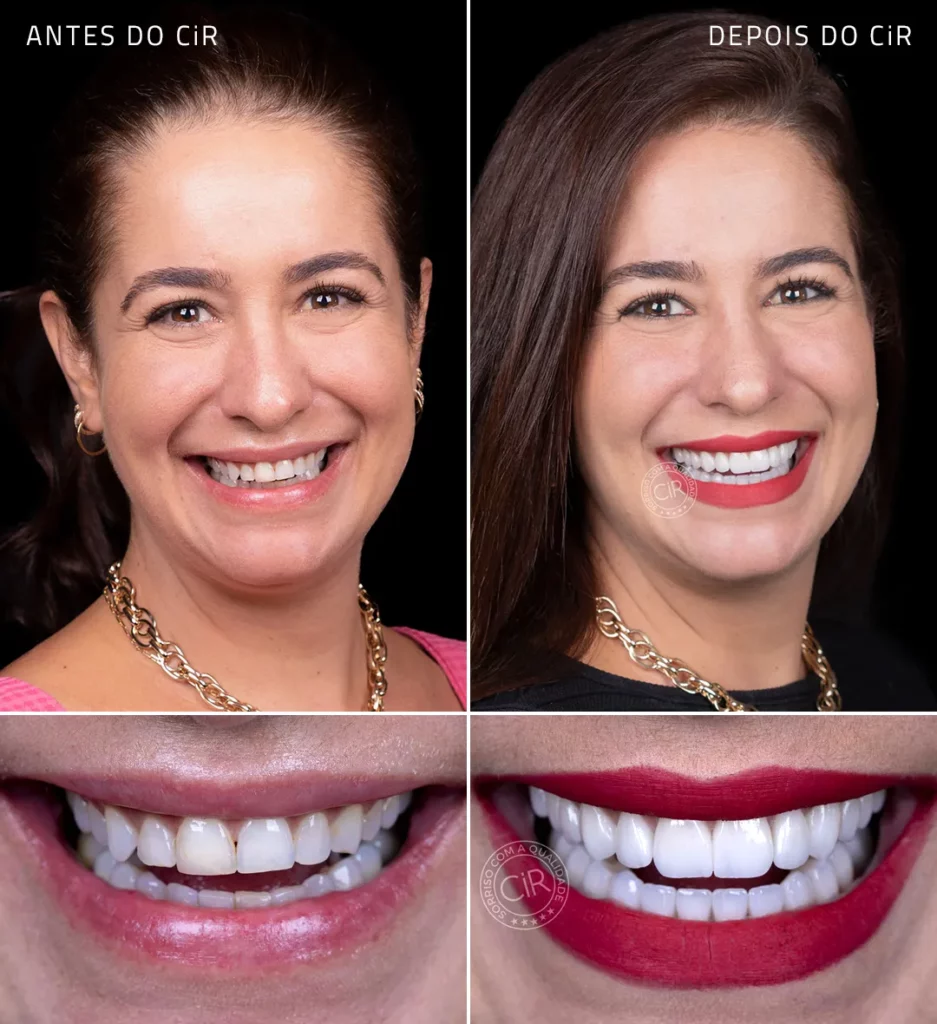 antes e depois da paciente de 42 anos que realizou lentes de contato dental em todos os dentes no cir hospital odontológico tratamento premium lago sul lago norte asa sul asa norte sudoeste