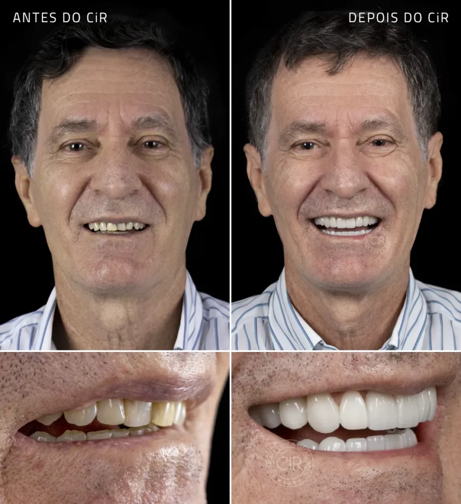 antes e depois dos implantes dentários paciente homem de 72 anos realizados no cir hospital odontológico