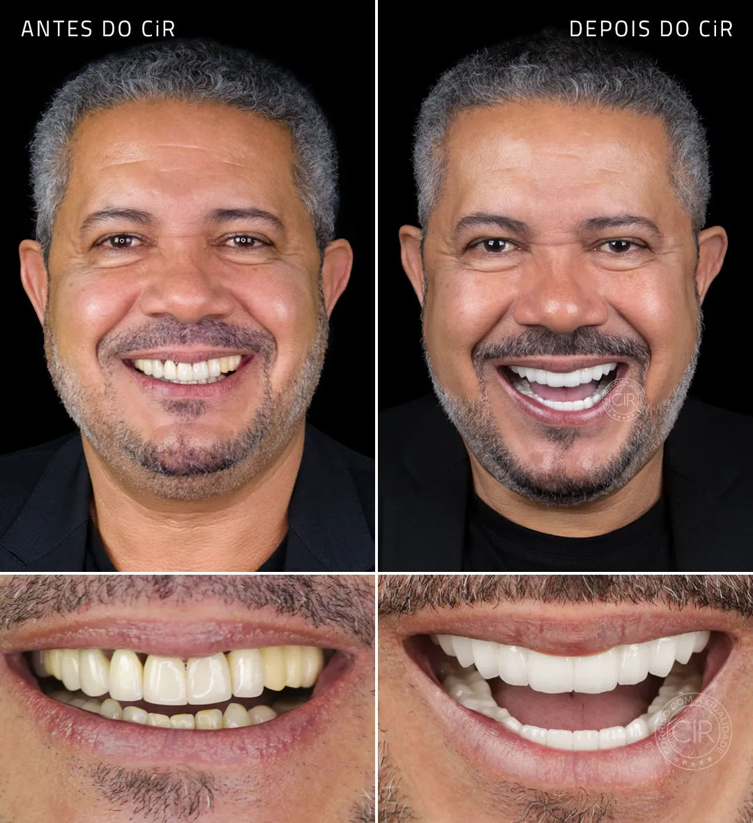 paciente masculino de 59 anos antes e depois do tratamento com implantes dentários com enxerto ósseo e carga imediata