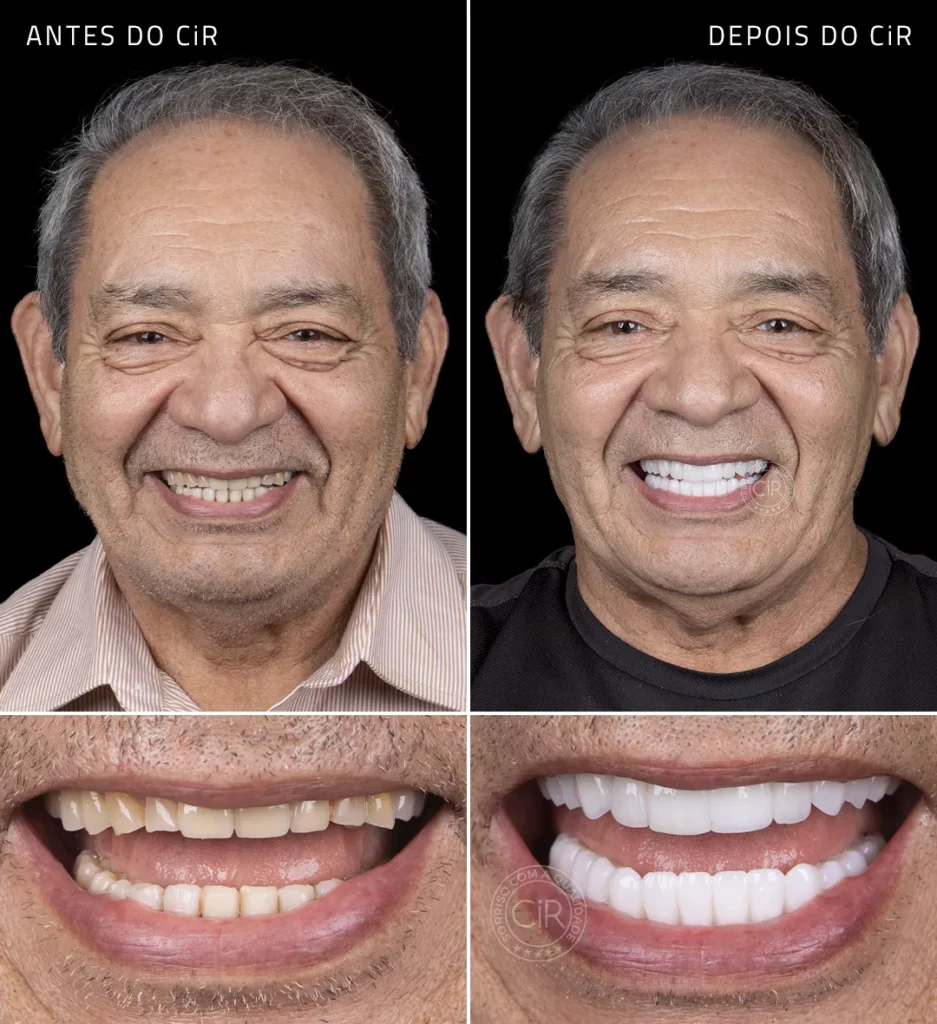 antes e depois do paciente homem de 80 anos que realizou implantes dentários com enxeto ósseo e carga imediata no cir hospital odontológico lago sul lago norte