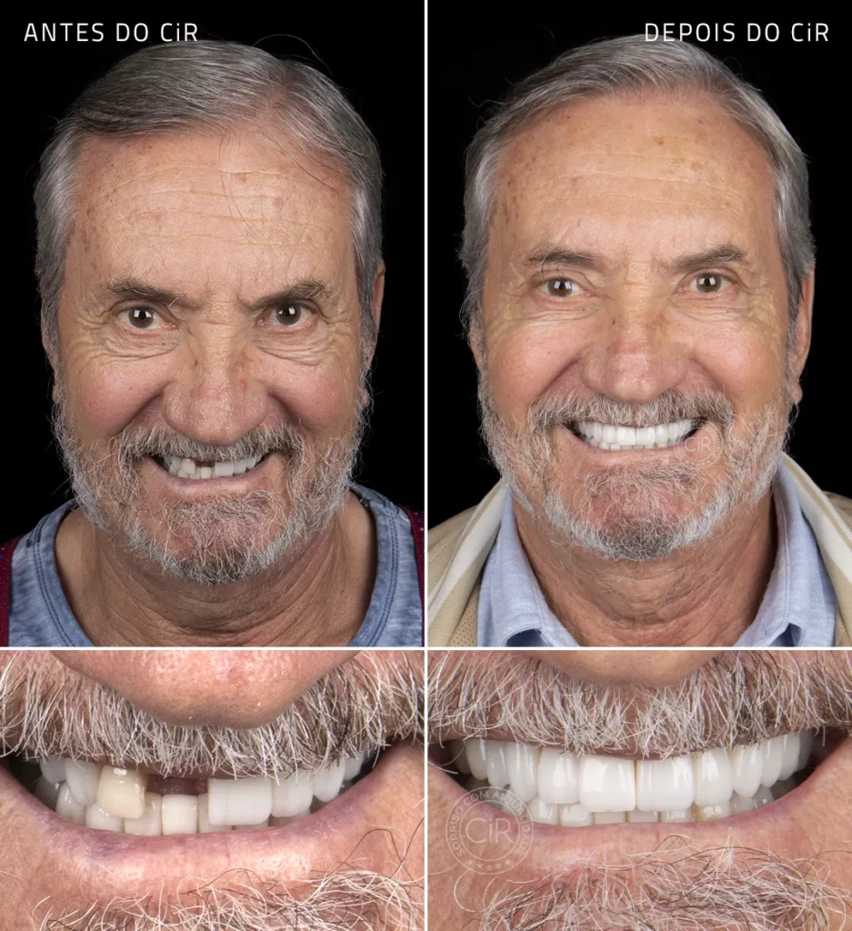 antes e depois do paciente homem de 74 anos que realizou implantes dentários com sedação endovenosa no cir hospital odontológico atendimento premium lago sul lago norte noroeste