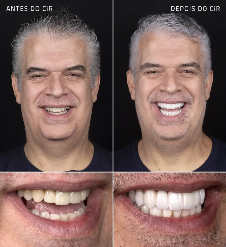 antes e depois do paciente masculino de 55 anos que realizou lentes em porcelana em todos os dentes no cir hospital odontológico