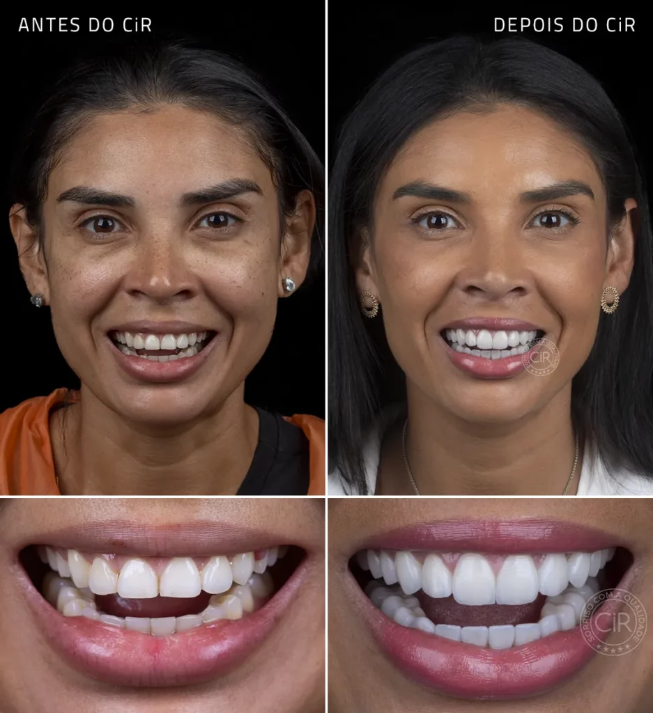 antes e depois da paciente de 37 anos que realizou lentes de contato dental em todos os dentes no cir hospital odontológico tratamento premium lago sul lago norte asa sul asa norte sudoeste