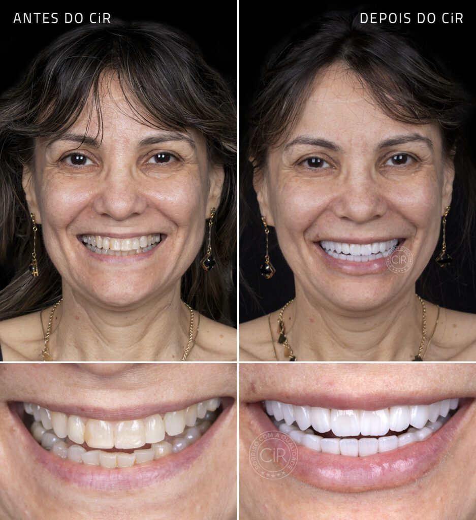antes e depois paciente mulher de 53 anos após lentes de contato dental em todos os dentes no cir hospital odontológico em brasília lago sul
