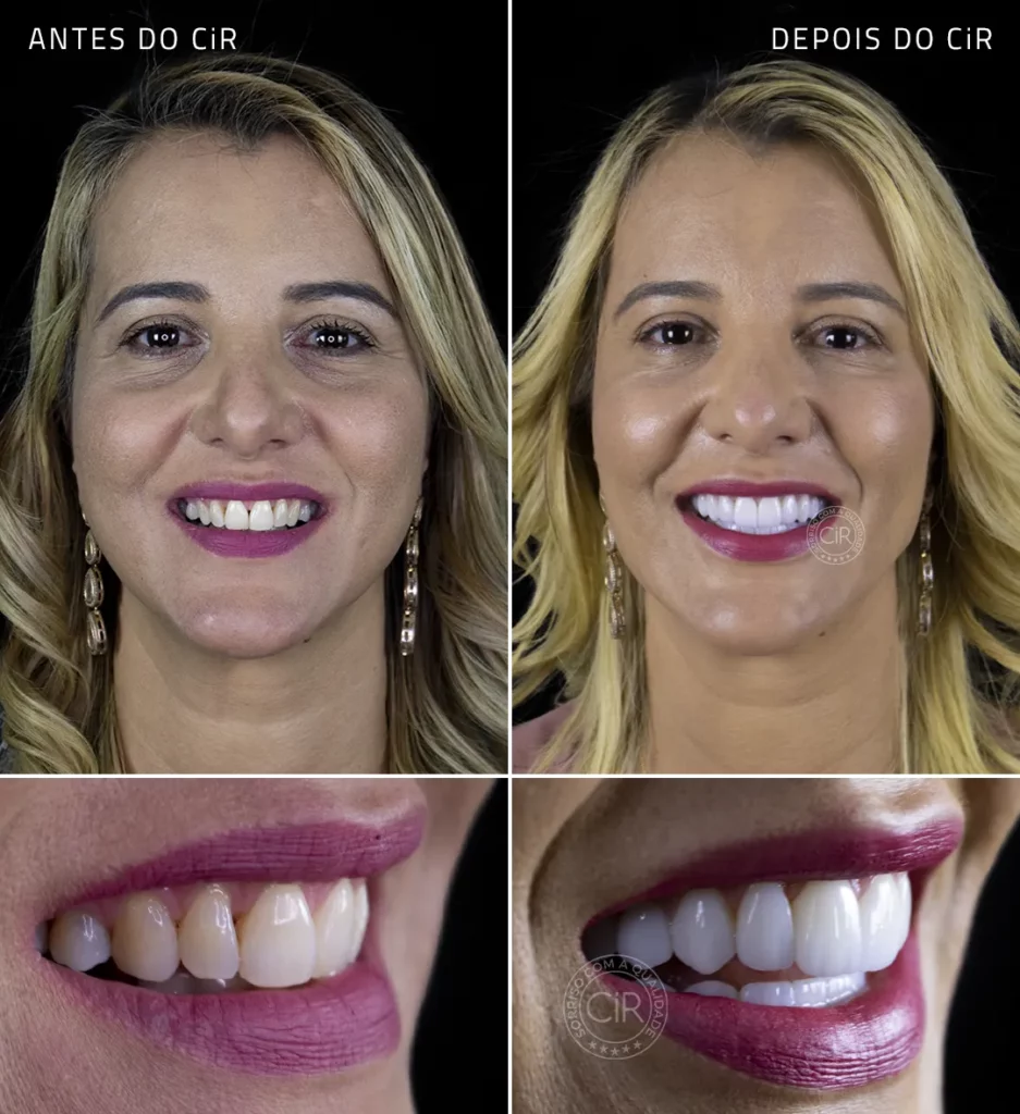 antes e depois da paciente de 43 anos que realizou lentes de contato dental em todos os dentes no cir hospital odontológico tratamento premium lago sul lago norte asa sul asa norte sudoeste