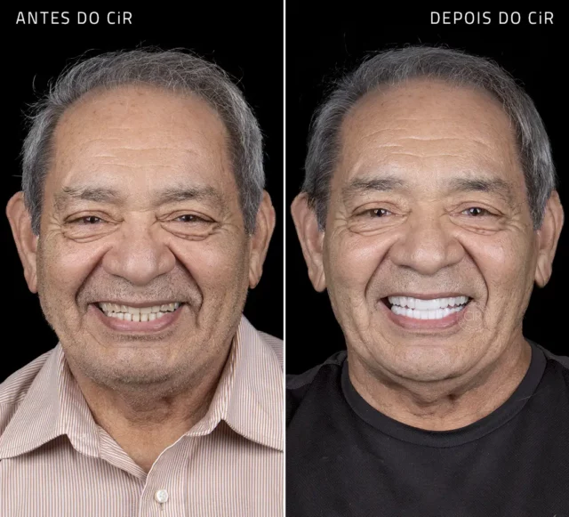 antes e depois de implantes dentários do nosso paciente masculino de 80 anos aqui no cir hospital odontológico de brasília lago sul