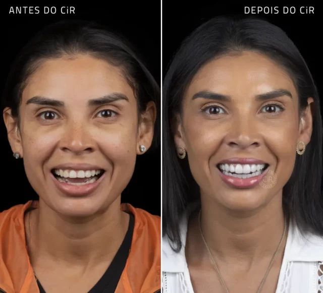 antes e depois da cirurgia de plástica gengival e lentes de contato dental em porcelana em todos os dentes da paciente feminina de 37 anos