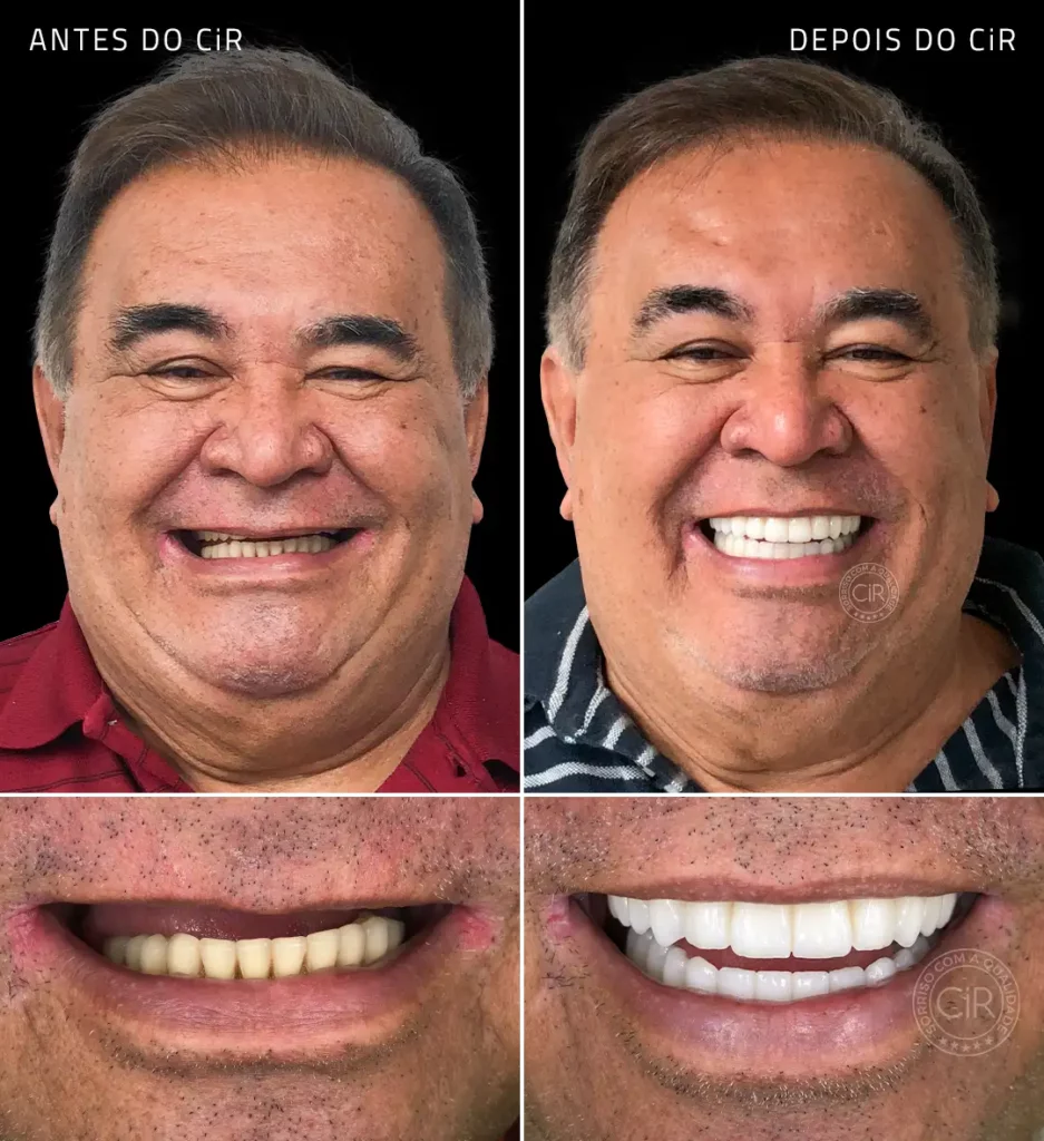 antes e depois do paciente de 66 anos que superou o medo de dentista e realizou implantes dentários com sedação no cir brasília lago sul