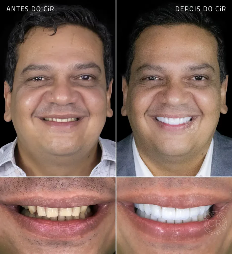 antes e depois do tratamento com as lentes em porcelana do paciente de 47 anos que sofria com medo de dentista