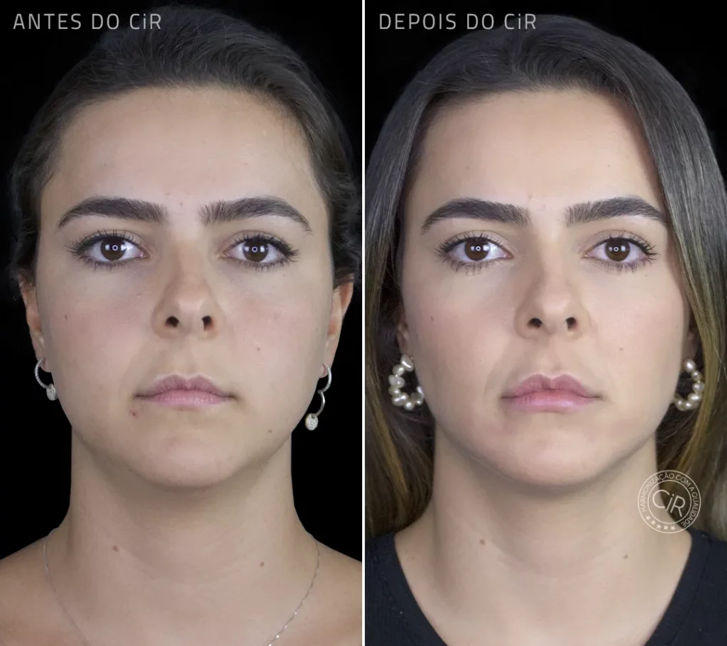 antes e depois da bichectomia da paciente de 29 anos no cir harmonização facial atendimento premium lago sul lago norte park way
