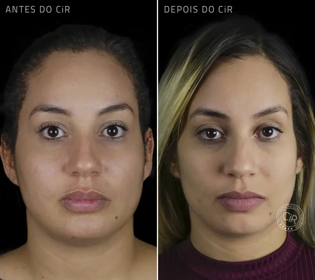 antes e depois da bichectomia da paciente de 28 anos no cir harmonização facial atendimento premium lago sul lago norte park way