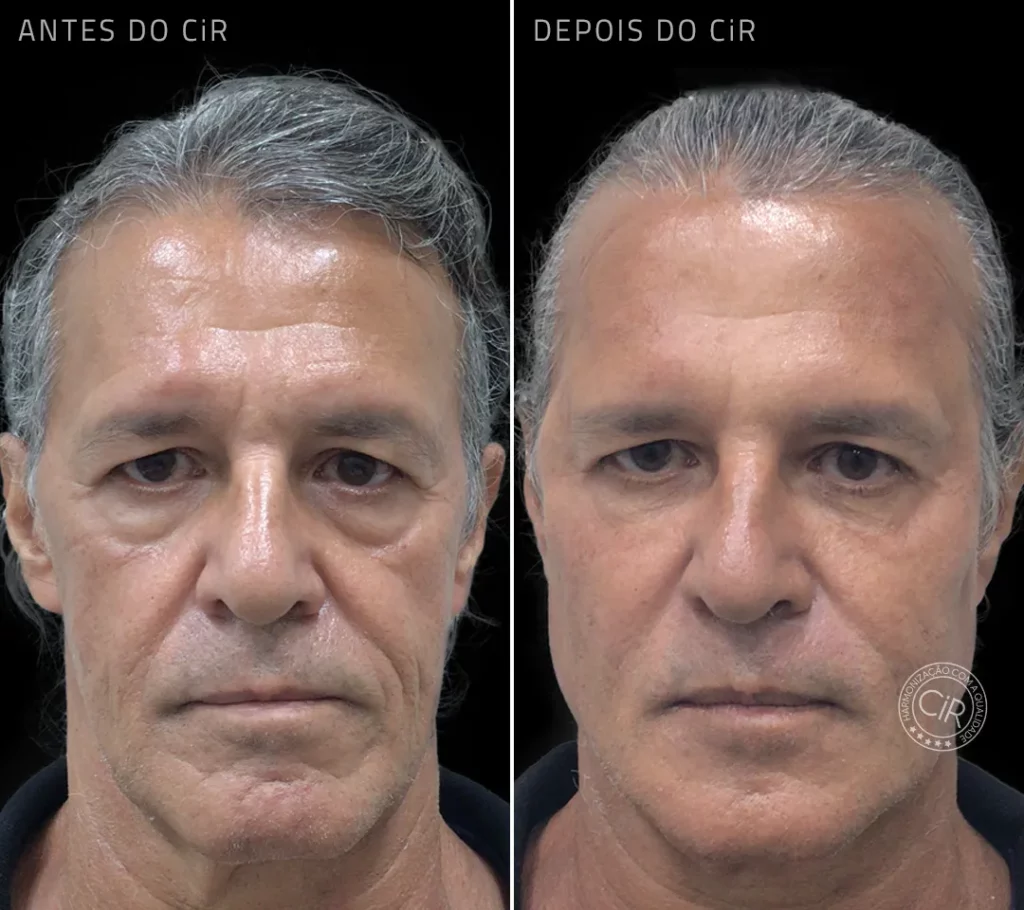 antes e depois do tratamento de peeling e botox em paciente masculino de 63 anos no cir harmonização facial