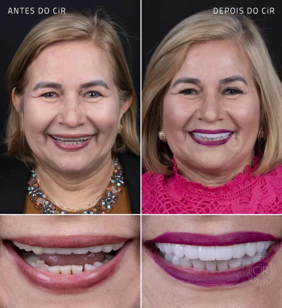 antes e depois dos implantes dentários da paciente de 59 anos cir hospital odontológico atendimento premium lago sul lago norte park way