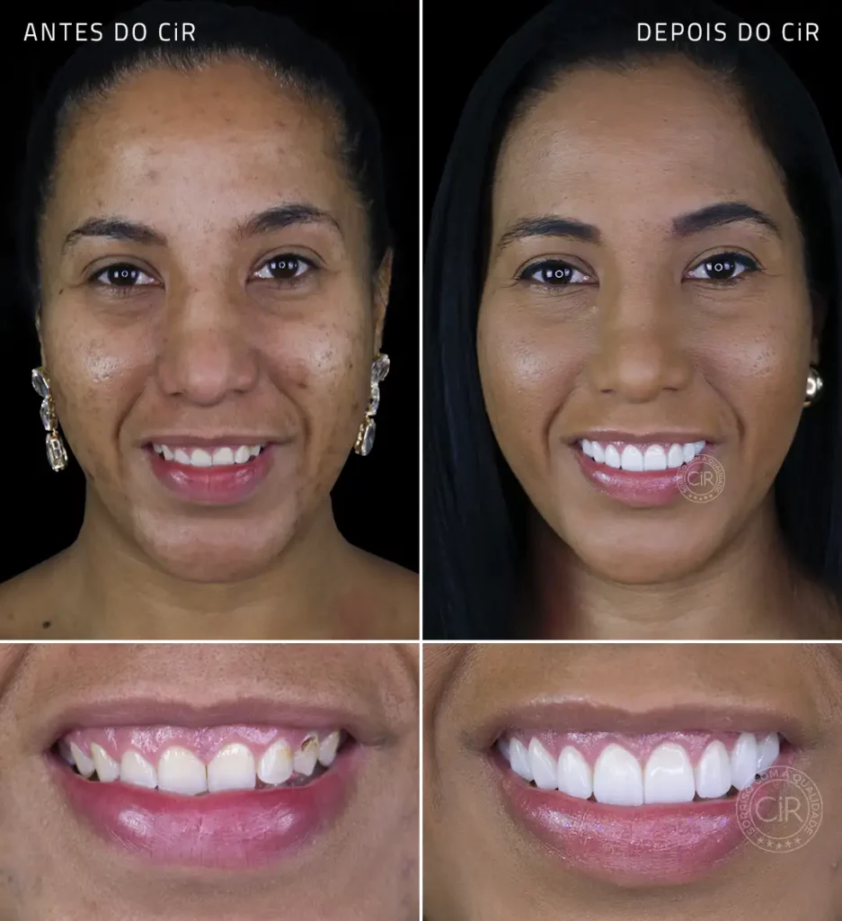 antes e depois da nossa paciente mulher que realizou plástica gengival e facetas dentais cir hospital odontológico lago sul brasília