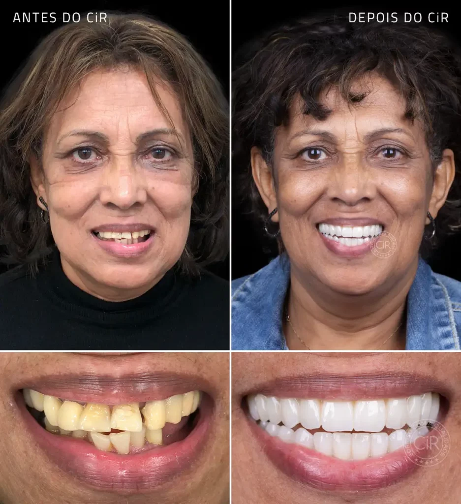 antes e depois da paciente de 61 anos que tinha muito medo de dentista implantes dentários enxerto ósseo e sedação endovenosa