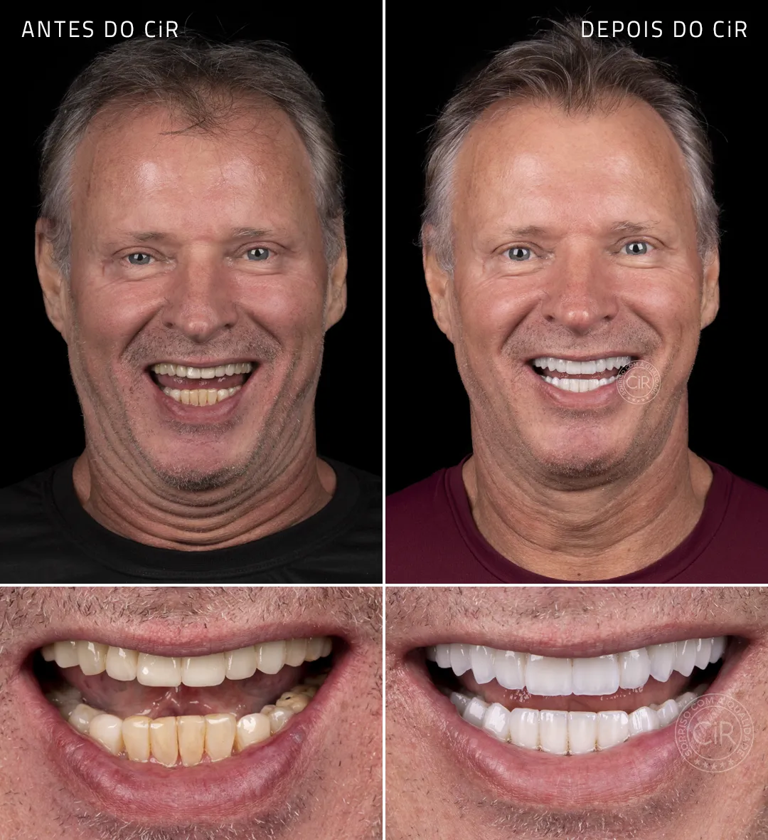 fernando-rosto-sorriso-antes-depois