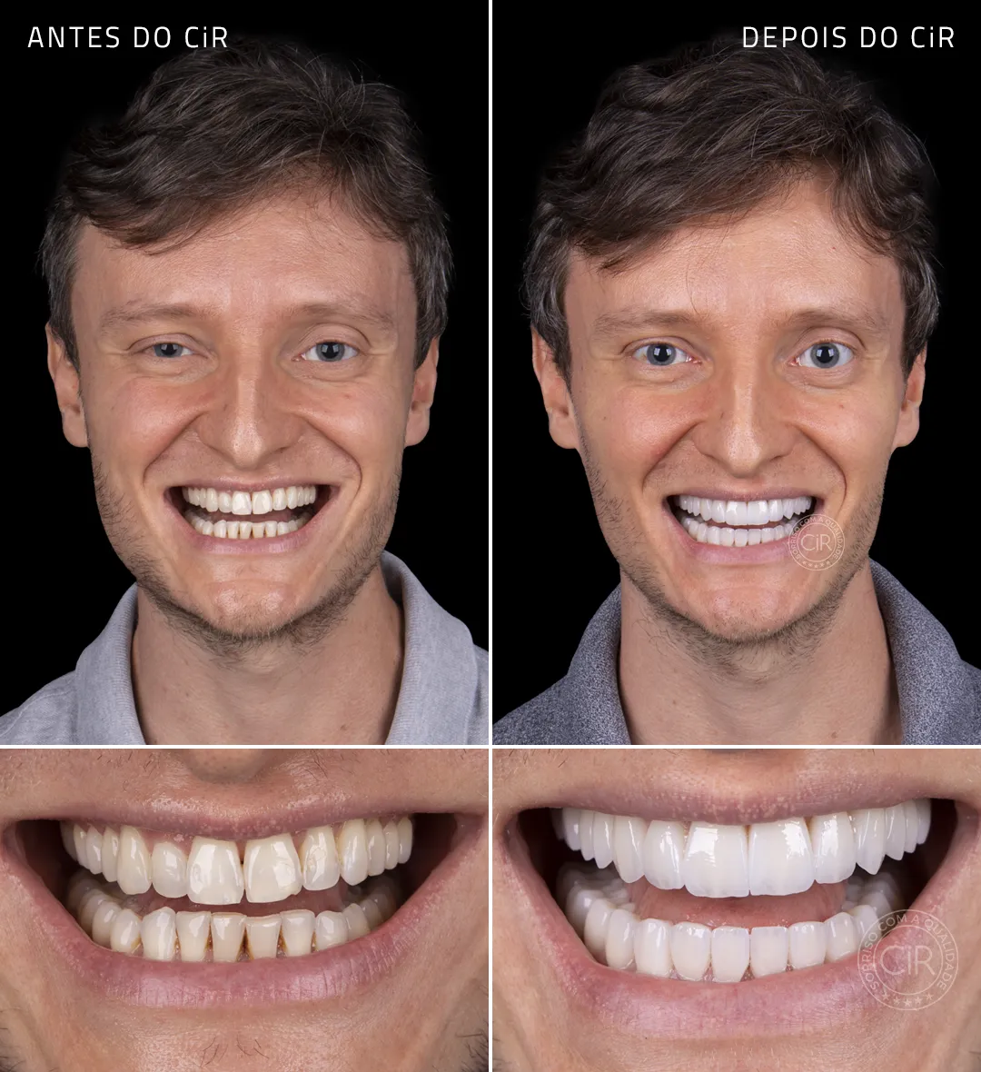 marcio-rosto-sorriso-antes-depois