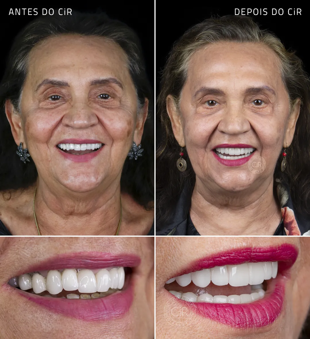 paciente-gardenha-implantes-dentarios-rosto-sorriso-antes-depois