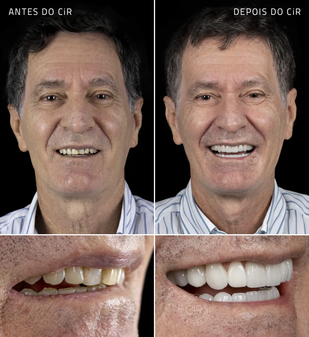 paciente-geraldo-implantes-dentarios-rosto-sorriso-antes-depois