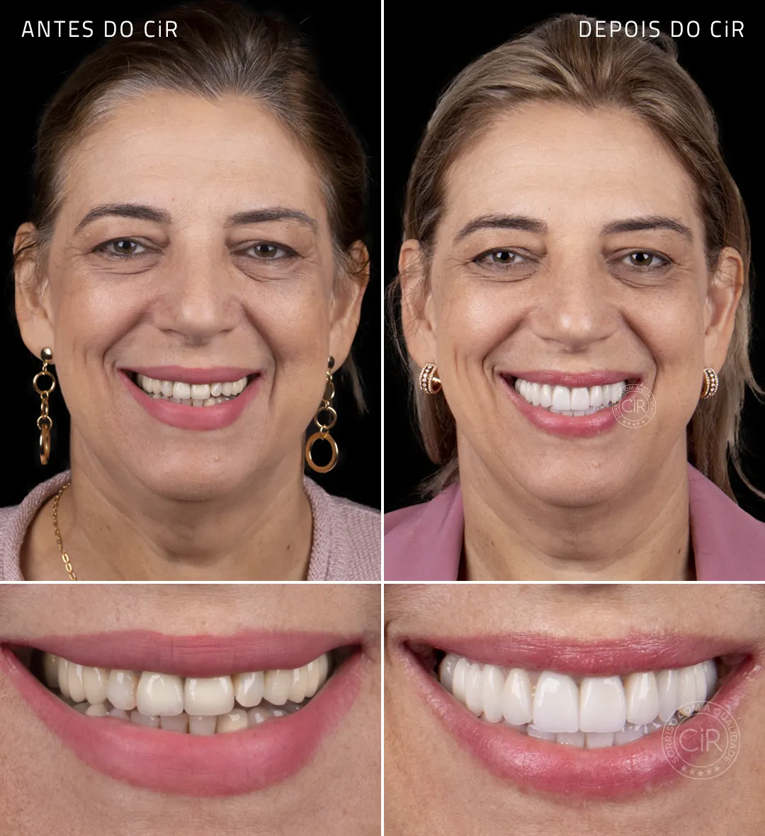 paciente-isabel-implantes-dentarios-rosto-sorriso-antes-depois
