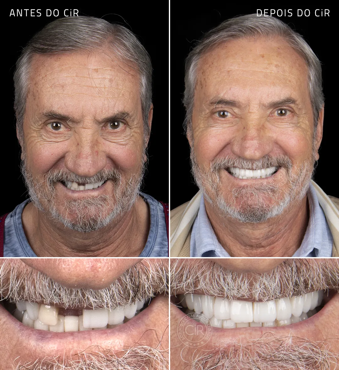 paciente-luiz-afonsi-implantes-dentarios-rosto-sorriso-antes-depois