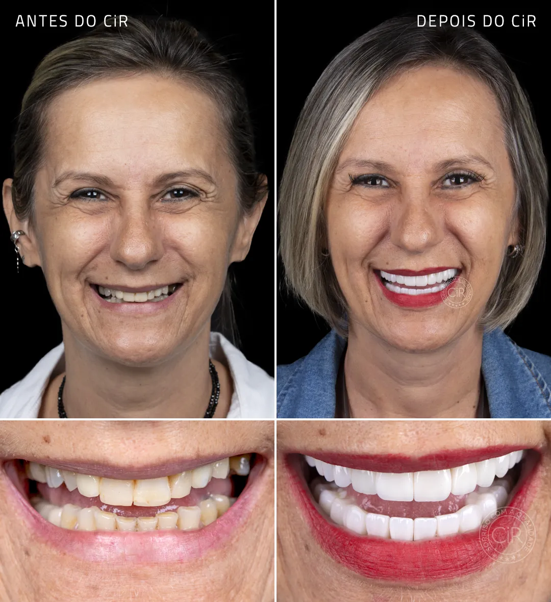 paciente-renata-implantes-dentarios-rosto-sorriso-antes-depois
