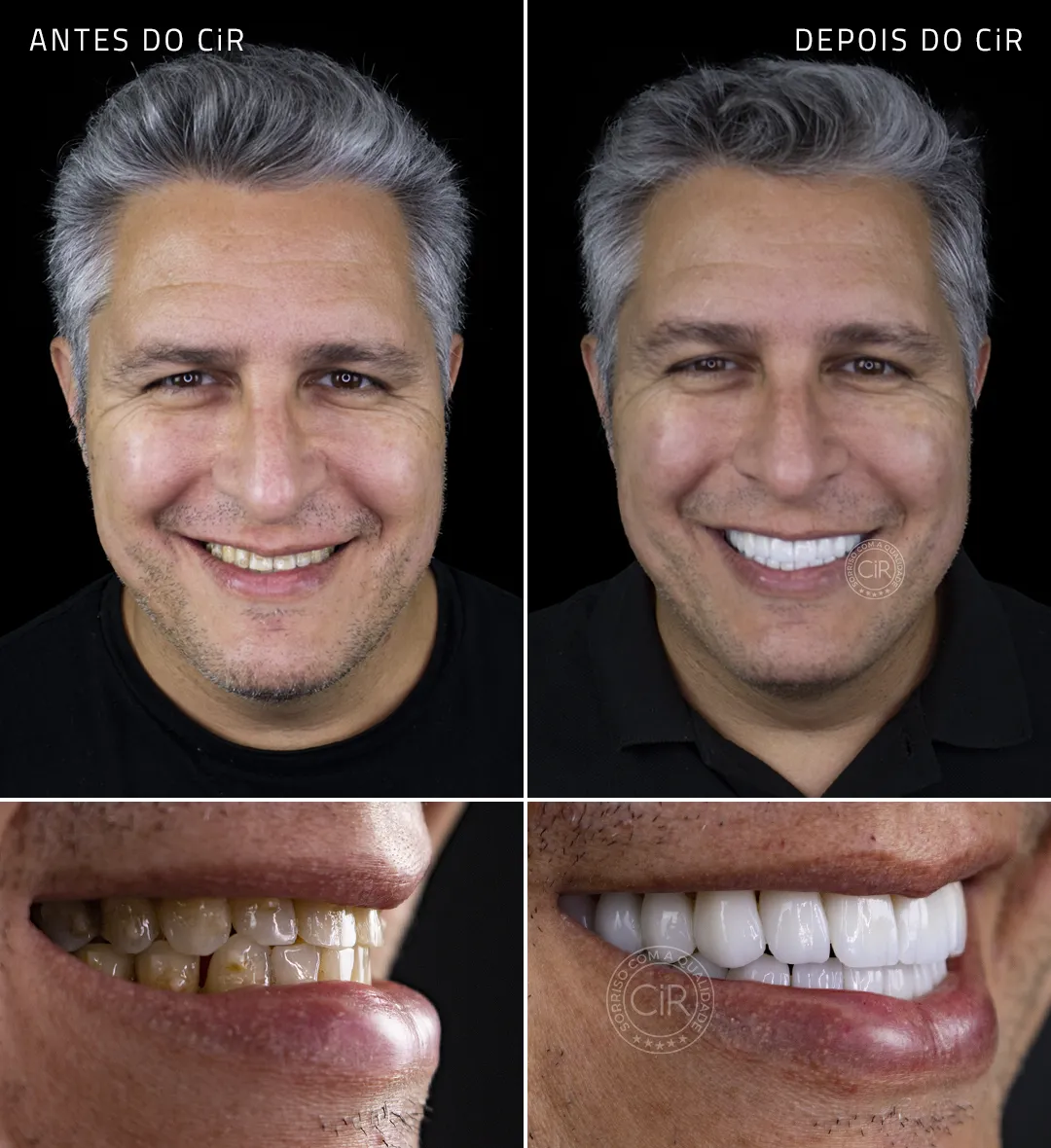 rodrigo-rosto-sorriso-antes-depois