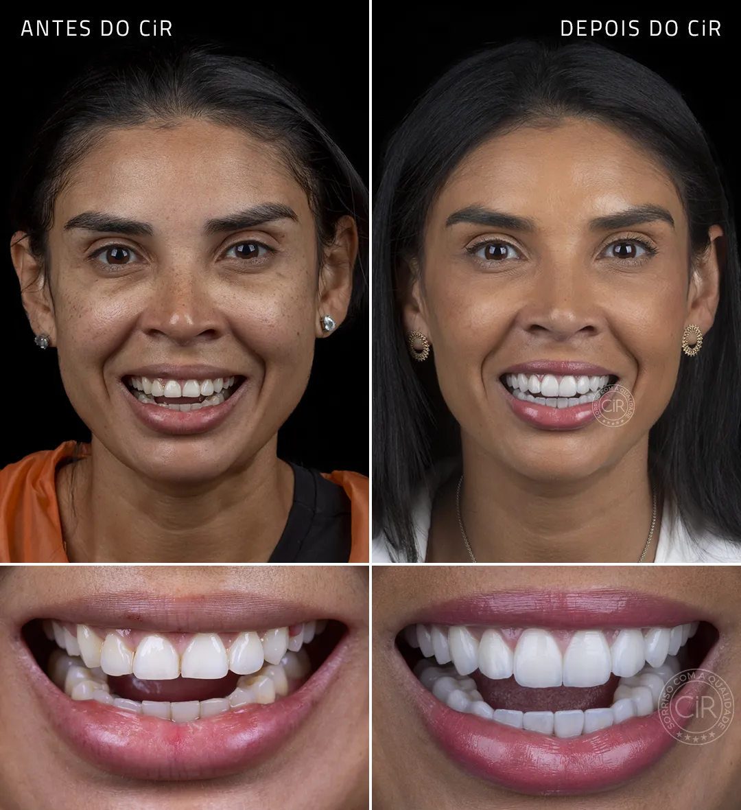 solange-lucilia-sorriso-antes-depois