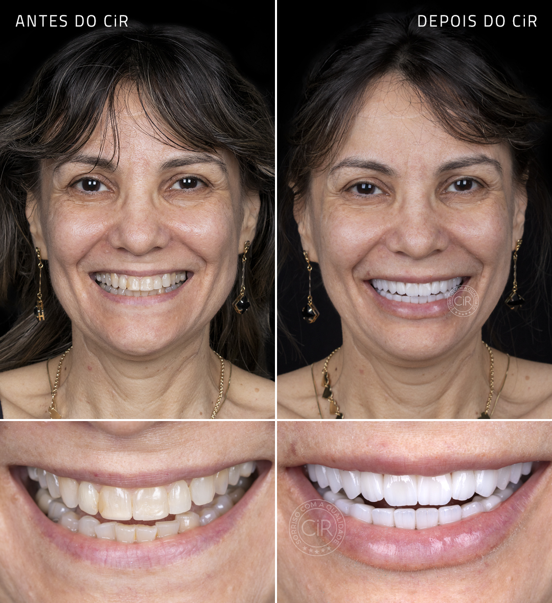 solange-rosto-sorriso-antes-depois