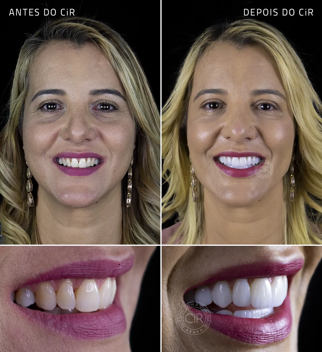 solange-rosto-sorriso-antes-depois