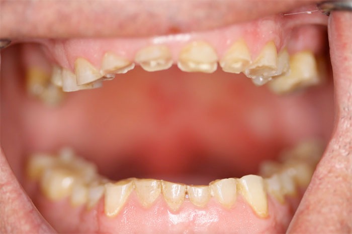 O que é bruxismo em adultos