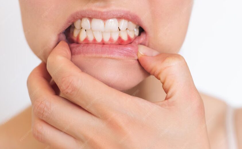 Inflamação na gengiva: é sempre gengivite?